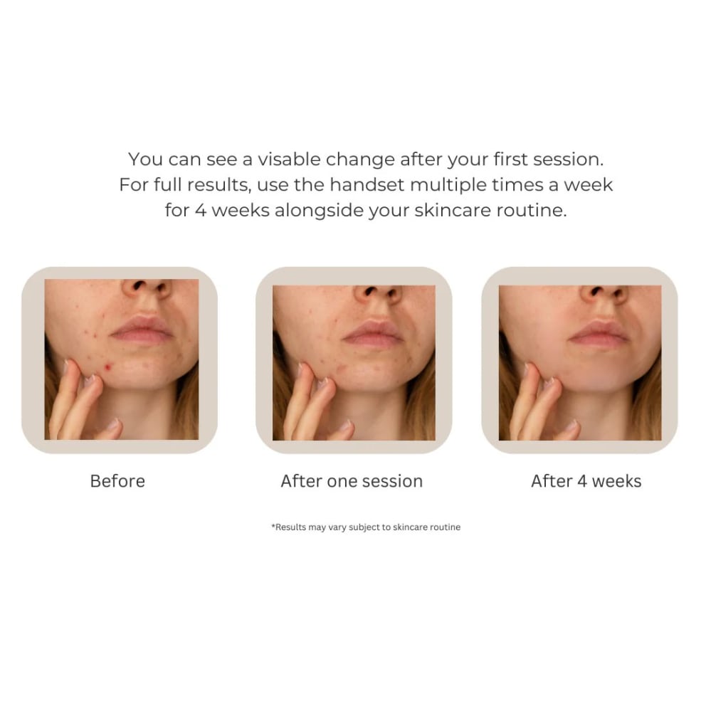 Get clearer skin with acne treatments