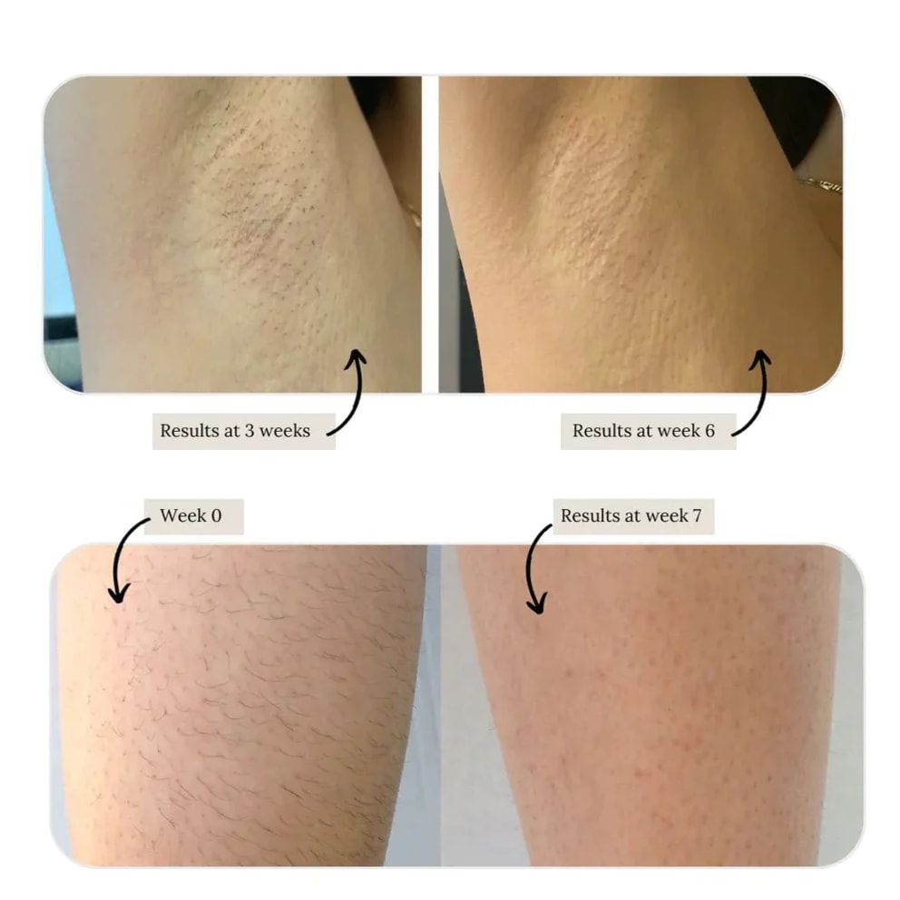 Visible, permanent hair removal