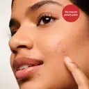 Best-selling blemish patch shrinks pimples in one use
