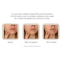 Get clearer skin with acne treatments