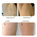Visible, permanent hair removal