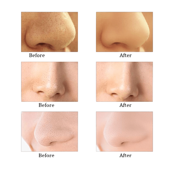 Vivitar Ultra Suction Pore Cleanser