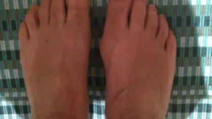 Needless and useless English word a day: bunyon or bunion