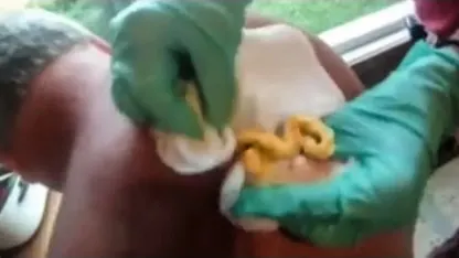 Cyst popping videos