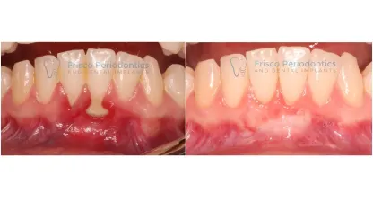 What do you need a gum for?