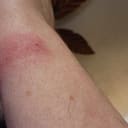 I'm NEVER allergic! ...'til now