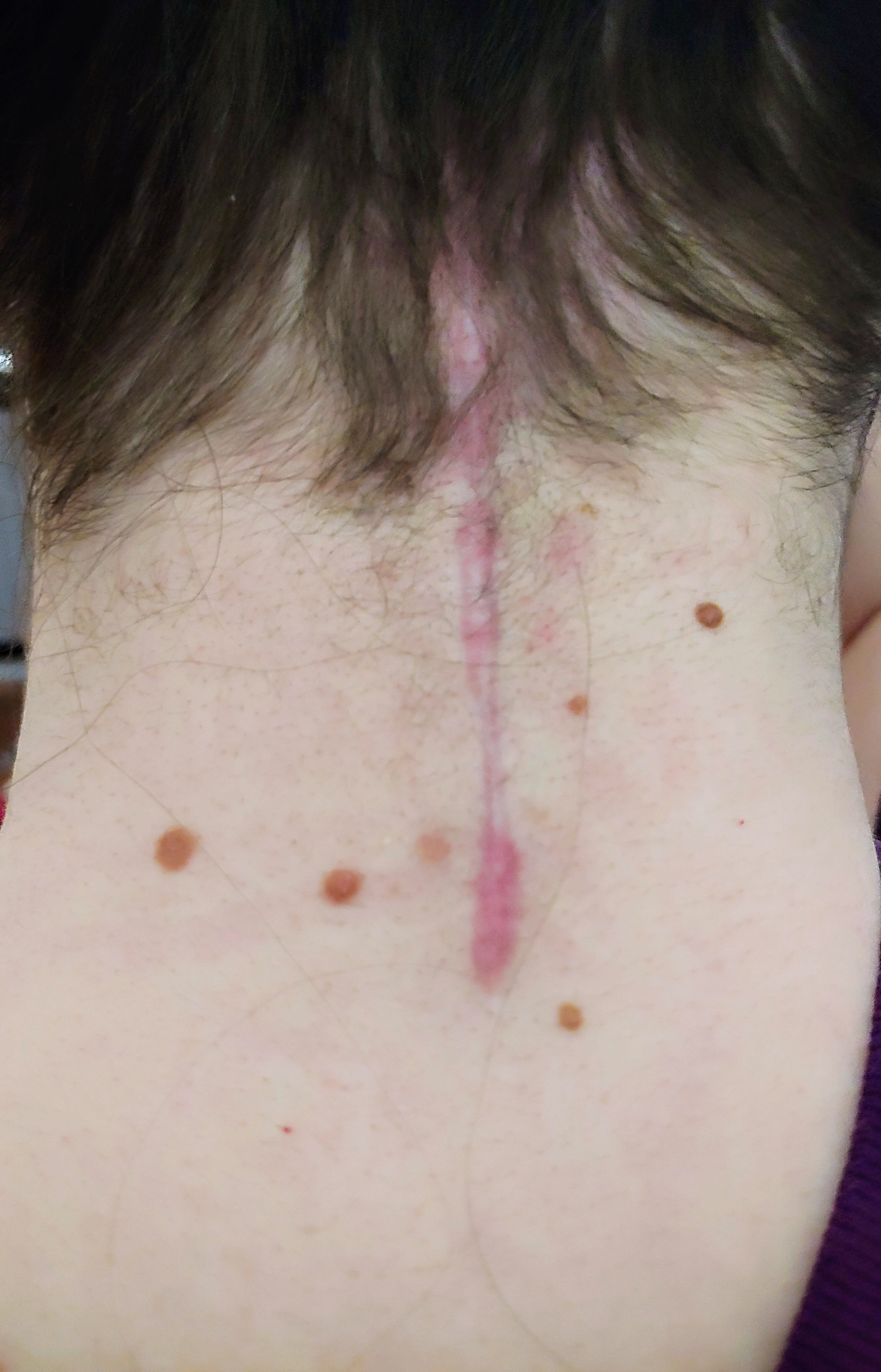 Picture of neurosurgical scar.